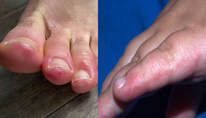 భయపెడుతోన్న కరోనా కొత్త లక్షణాలు