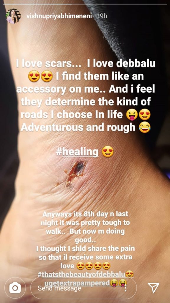 Anchor Vishnu Priya Leg Injured