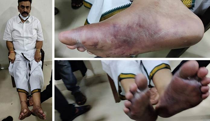 ఎంపీ రఘురామకి ఆ గాయాల్లేవా? అయితే ఈ రగడ ఎందుకు?