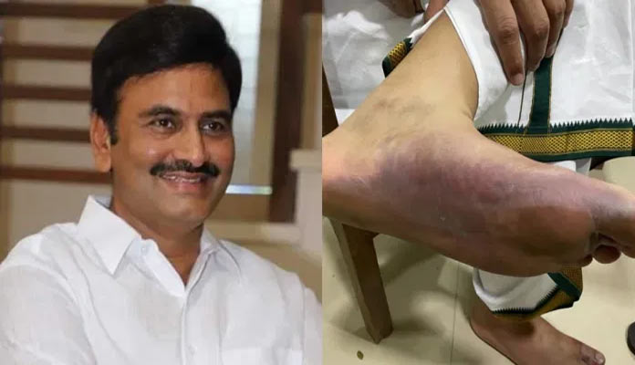 serious swelling on Raghurama's feet