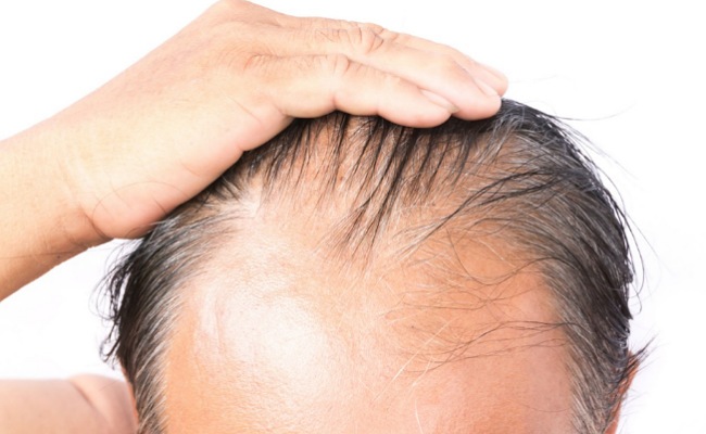 బట్టతల వస్తుందని భయపడుతున్నారా… ఈ చిట్కాలతో చెక్ పెట్టండి!