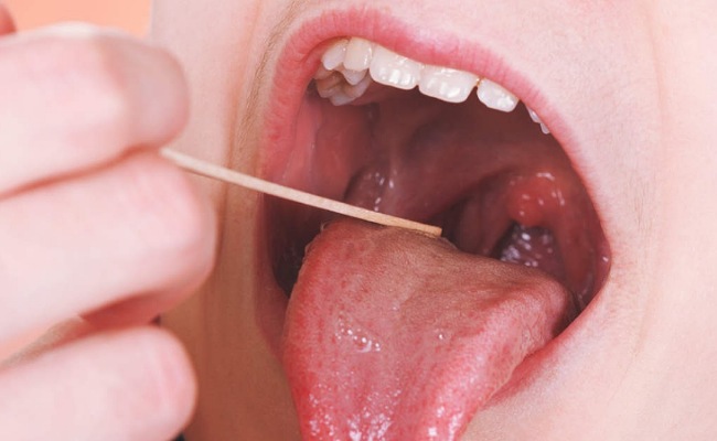 Tonsils: టాన్సిల్స్ సమస్య నుంచి విముక్తి పొందాలంటే ఈ చిట్కాలు పాటించాల్సిందే!