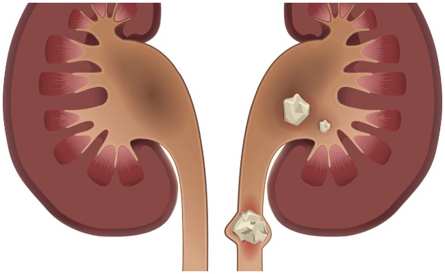 కిడ్నీ రాళ్ల సమస్యతో బాధపడుతున్నారా.. ఈ ఇంటి చిట్కాలతో చెక్ పెట్టండి!