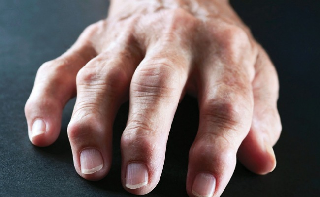 Health Binifits: శీతాకాలంలో ఈ లక్షణాలు బాధిస్తున్నాయా.. అయితే ఇది ఆర్థరైటిస్ కి సంకేతం!