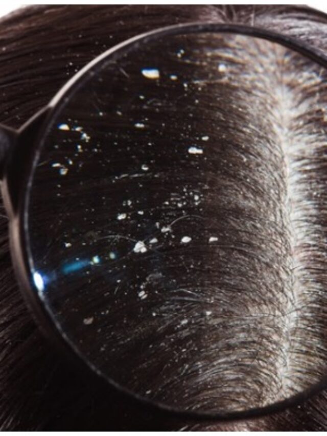 చుండ్రు సమస్య తీవ్రంగా వేధిస్తోందా..? ఇంటి చిట్కాలతో ఇలా తరిమికొట్టండి!