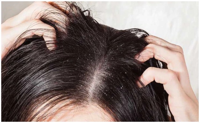 చుండ్రు సమస్యతో ఇబ్బంది పడుతుంటే ఈ చిట్కాలను పాటించి మంచి ఫలితాలను పొందండి..