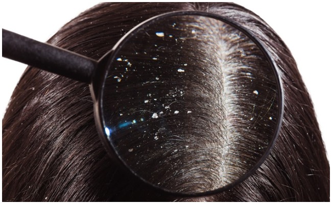 చుండ్రు సమస్య మళ్లీమళ్లీ బాధిస్తోందా? కారణాలు, విముక్తి పొందే మార్గాలు!