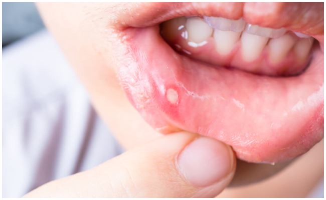 నోటి అల్సర్ సమస్యతో ఇబ్బందిగా ఉందా? ఈ సులువైన చిట్కాలు మీకోసమే?