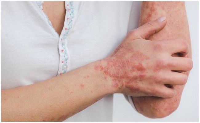 Health Tips: ఈ లక్షణాలు కనిపిస్తే జాగ్రత్త.. బ్లడ్ క్యాన్సర్ కు దారితీసే ప్రమాదం ఎక్కువ..!