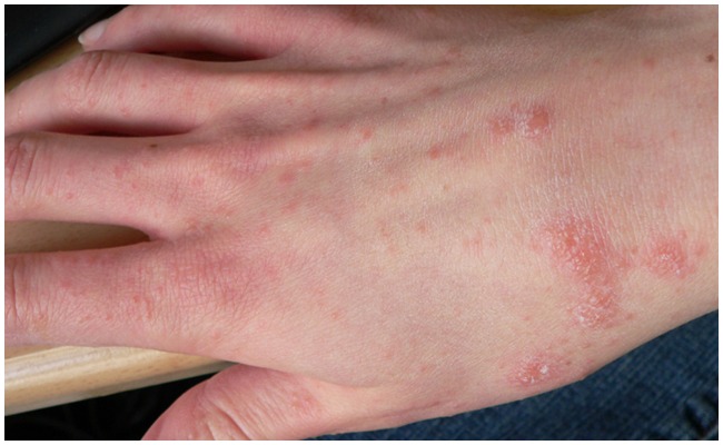 Health Rashes: ఎండాకాలం హీట్ ర్యాషెస్ సమస్యలతో బాధపడుతున్నారా..ఈ వంటింటి చిట్కాలను పాటించాల్సిందే..?
