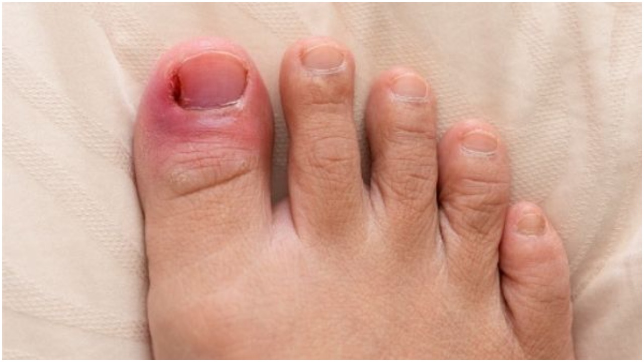 Fungal Nail Infection : గోటిపై ఫంగస్ ఏర్పడి నొప్పితో సతమతమవుతున్నారా… ఈ సింపుల్ చిట్కాతో నొప్పికి చెక్ పెట్టండి!