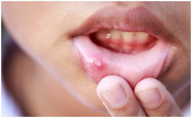 Oral Cancer: మీలో ఈ లక్షణాలు కనిపిస్తున్నాయా? జాగ్రత్త నోటి కేన్సర్ కి దారితీసే ప్రమాదం ఉంది..!