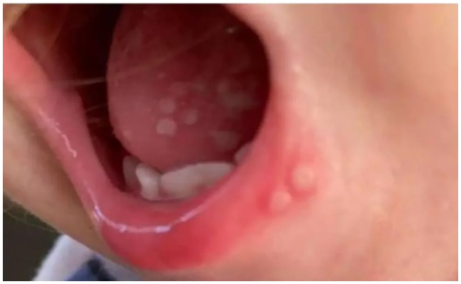 Tomato Flu Virus: కేరళని వణికిస్తున్న టమోటా ఫ్లూ.. పదుల సంఖ్యలో కేసులు నమోదు..?