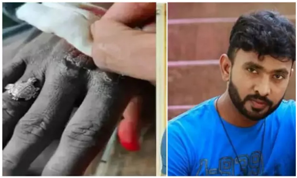 జబర్దస్త్ కమెడియన్ అదిరే అభికి ప్రమాదం.. ఏకంగా 15 కుట్లు!