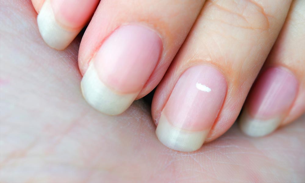 గోళ్లపై తెల్లని మచ్చలు వస్తున్నాయా? జాగ్రత్త శరీరంలో ఈ విటమిన్స్ లోపించినట్టే…?