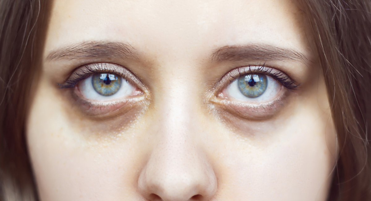 సహజ పద్ధతిలో కళ్ళ చుట్టూ ఏర్పడే నల్లని వలయాలను తగ్గించుకోవడం ఎలాగో తెలుసా?