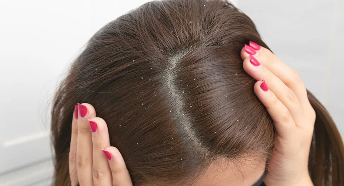 చుండ్రు సమస్యతో బాధపడుతున్నారా అయితే ఓసారి ఇలా ప్రయత్నించండి..