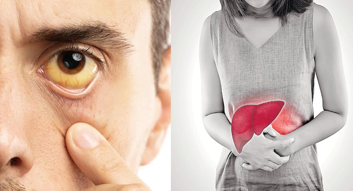 కామెర్లు – కాలేయ సమస్యలతో బాధపడుతున్నారా అయితే ఈ ఆహార నియమాలతో సమస్యకు చెక్ పెట్టండి!