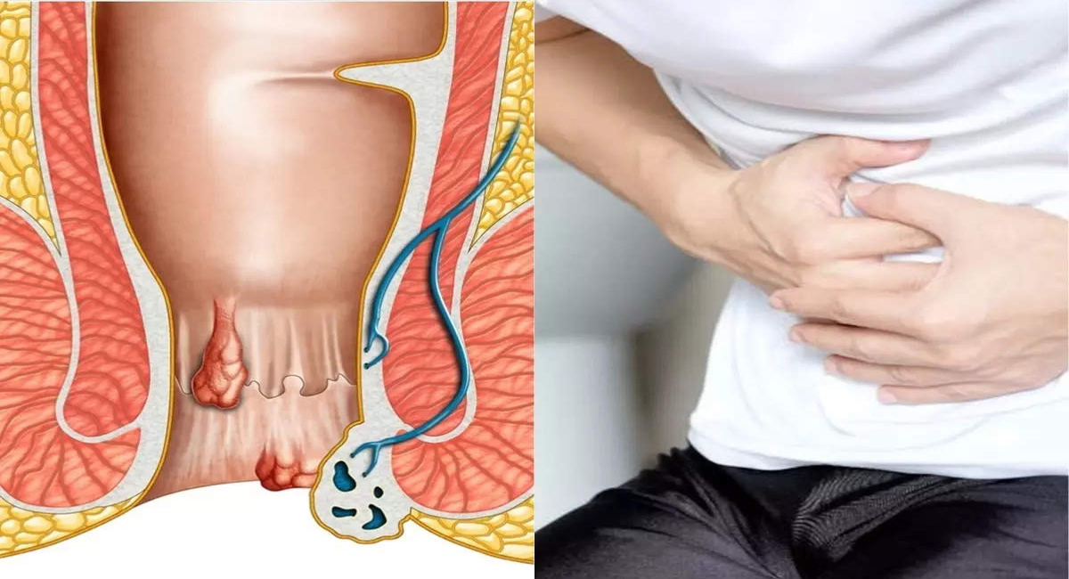 పైల్స్ ఎందుకు వస్తాయో తెలుసా.. ఎలాంటి జాగ్రత్తలు తీసుకోవాలో తెలుసా?