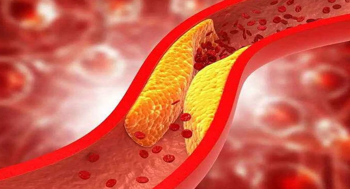 చెడు కొలెస్ట్రాల్,ఫ్యాటీ లివర్ తో బాధపడేవారు ఈ ఉపాయాన్ని ఫాలో అయితే చాలు సమస్యకు చెక్ పెట్టవచ్చు!