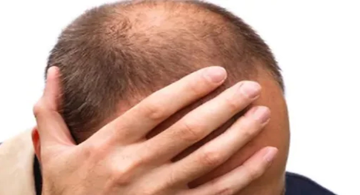 యుక్త వయస్సులోనే బట్టతల సమస్య వేధిస్తోందా? కారణాలు ఇవే కావచ్చు… జాగ్రత్త పడండి!