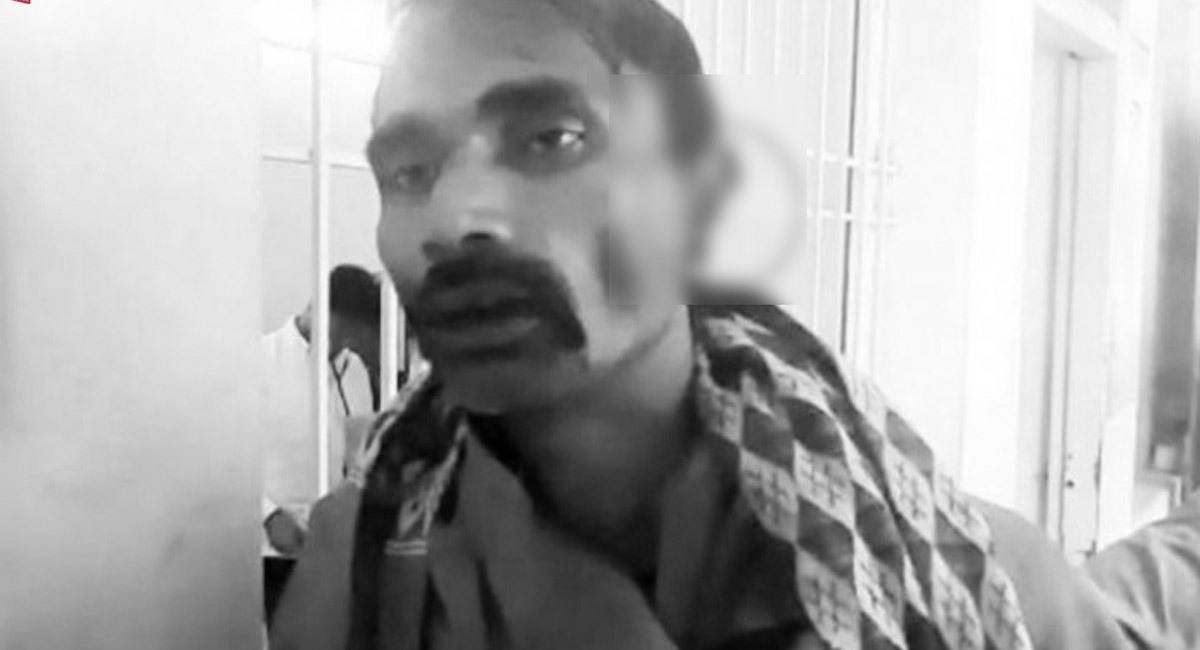 కోపంతో మృగంలా మారి మామయ్య చెవిని కొరికిన అల్లుడు.. ఎక్కడంటే?