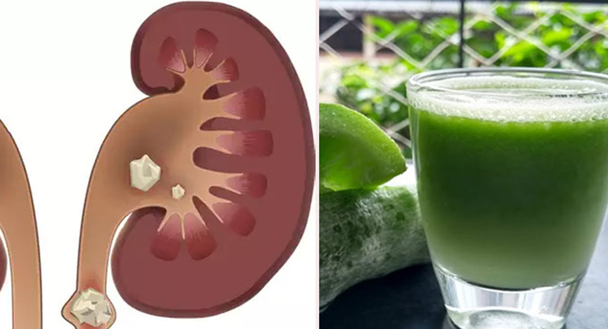 యూరిన్ ఇన్ఫెక్షన్, కిడ్నీ వ్యాధులు ఉన్నవారు ఈ జ్యూస్ సేవిస్తే అద్భుత ఫలితం మీ సొంతం!