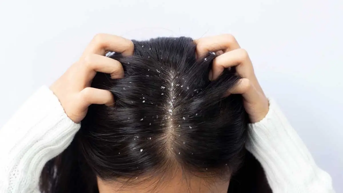 చుండ్రు సమస్య వల్ల జుట్టు రాలుతోందా.. సులువుగా చెక్ పెట్టే చిట్కాలు ఇవే!