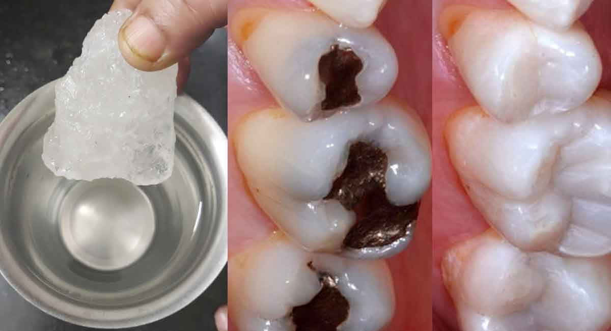 పుచ్చిపోయిన దంతాలు నొప్పిని కలిగిస్తున్నాయా…. ఈ సింపుల్ చిట్కాతో నొప్పికి చెక్ పెట్టండి!