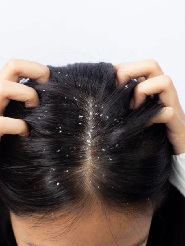 చుండ్రు సమస్యతో బాధపడుతున్నారా …..ఇలా చెక్ పెట్టండి!