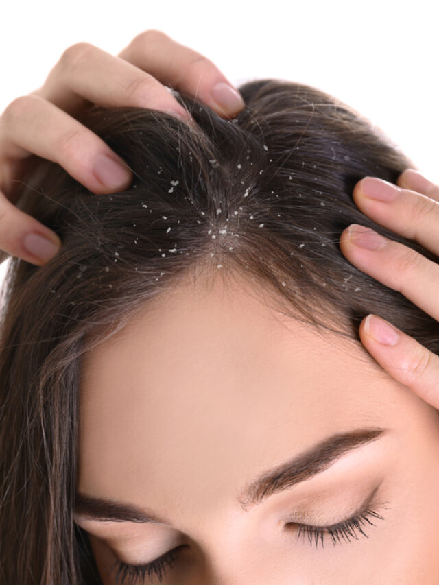 చుండ్రు సమస్యతో బాధపడుతున్నారా… ఈ ఆహార పదార్థాలతో సమస్యకు చెక్ పెట్టవచ్చు!