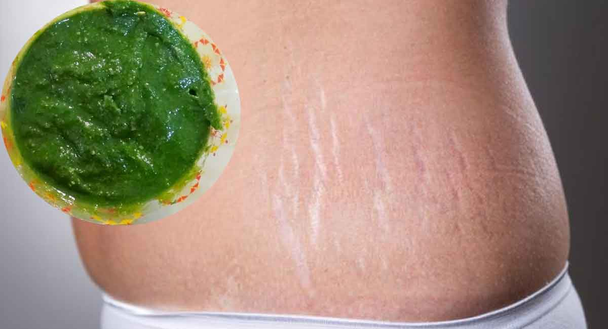 ప్రసవం తర్వాత పొట్టపై స్ట్రెచ్ మార్క్స్ తో ఇబ్బంది పడుతున్నారా…. ఇది రాస్తే చాలు?