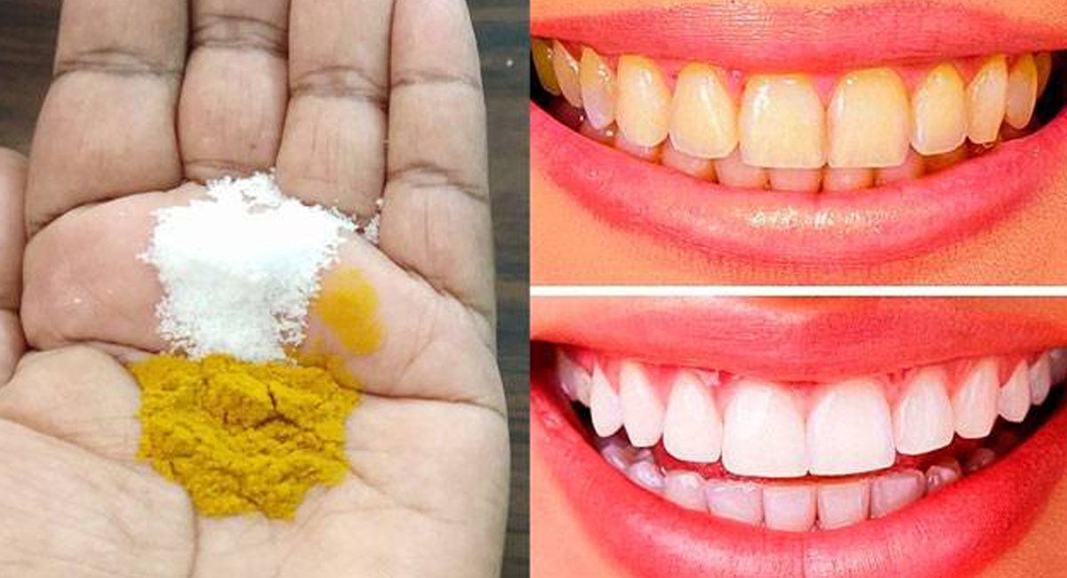 పసుపు పచ్చ దంతాలతో నలుగురిలో మాట్లాడలేకపోతున్నారా… ఈ సింపుల్ చిట్కాతో సమస్యకు చూపెట్టండి!