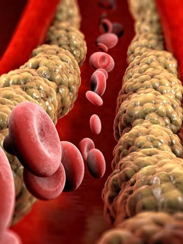 ఒంట్లో చెడు కొలెస్ట్రాల్ పెరుగుతోంది అనడానికి ఇవే ముఖ్య సూచికలు!