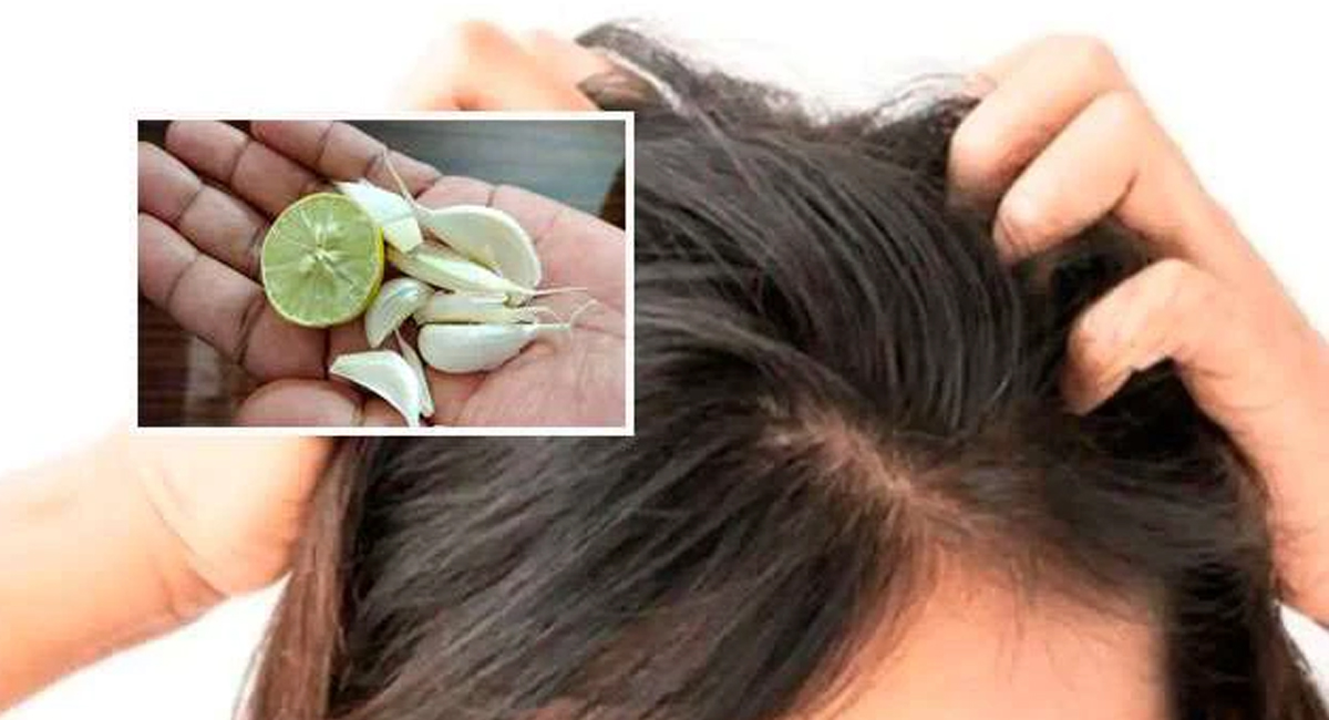 నిమ్మకాయ వెల్లుల్లితో ఇలా చేస్తే చాలు జీవితంలో చుండ్రు రాదు!