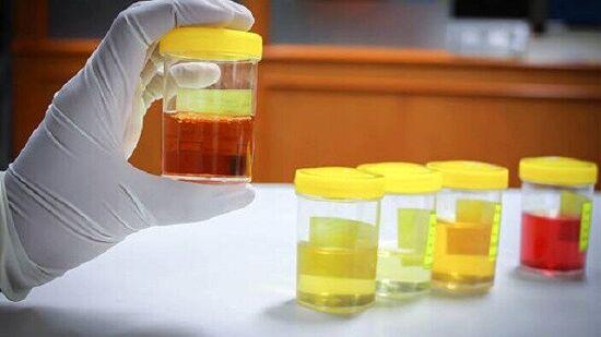 మూత్రం రంగును బట్టి ఆరోగ్య సమస్యలను తెలుసుకోవచ్చా.. ఏ రంగు ఉంటే ఏ సమస్య అంటే?