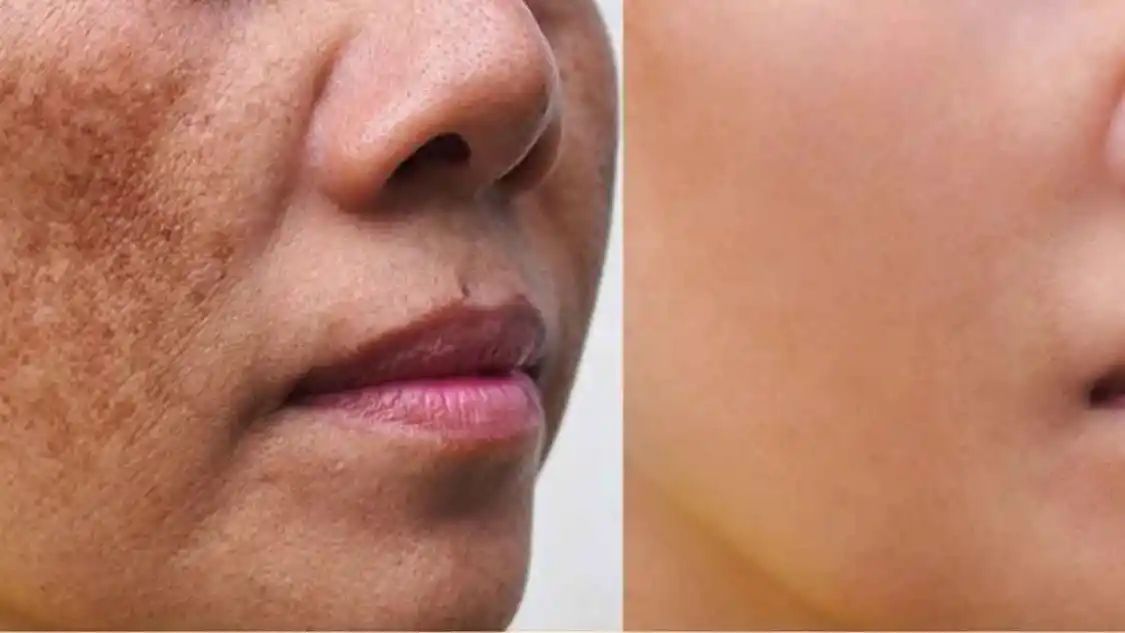 ముఖంపై మొంగు మచ్చల వల్ల ఇబ్బందులు పడుతున్నారా.. ఈ సమస్యకు చెక్ పెట్టే చిట్కాలివే!