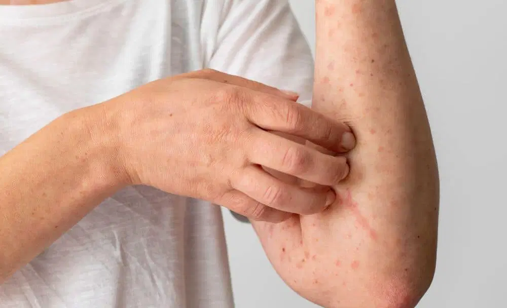 చర్మంపై తరచూ ఎర్రటి దద్దుర్లు వస్తున్నాయా.. ఈ సమస్యకు చెక్ పెట్టే చిట్కాలు ఇవే!