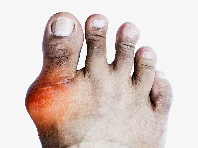 శరీరంలో యూరిక్ యాసిడ్ పెరగడం వల్ల ఇన్ని నష్టాలున్నాయా.. ఏం జరిగిందంటే?