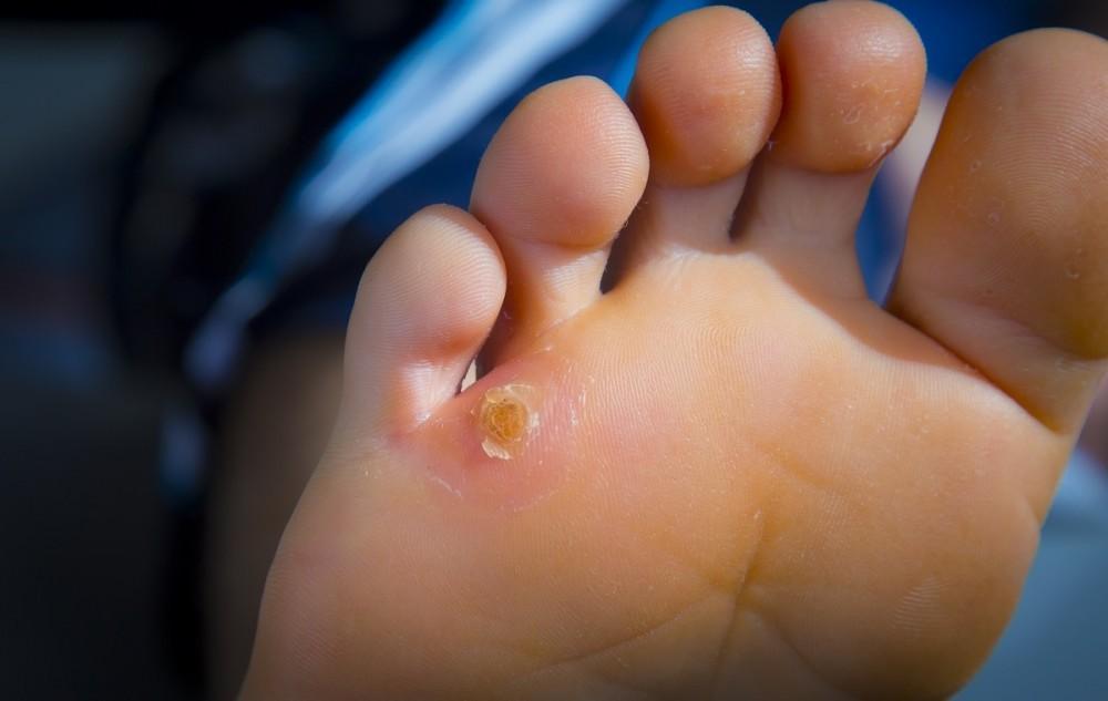 అరికాళ్లలో ఆనెల వల్ల ఇబ్బందులు పడుతున్నారా.. ఈ చిట్కాలు పాటిస్తే ఆ సమస్యకు చెక్!