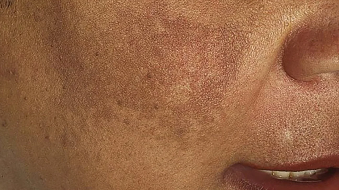 ఈ పనులు చేస్తే మంగు మచ్చలు, డార్క్ మార్క్స్ సులువుగా దూరం.. ఏం చేయాలంటే?