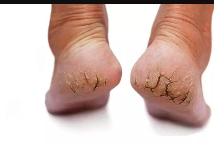 మడమల పగుళ్లకు అద్భుతమైన చిట్కాలు ఇవే.. ఈ చిట్కాలు పాటిస్తే ఆ సమస్యలు దూరం?