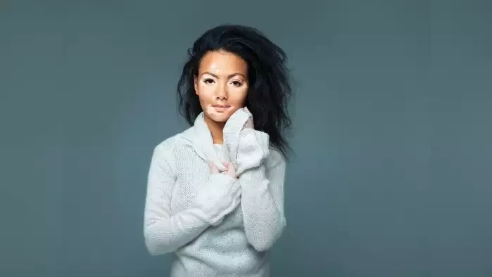 బొల్లి మచ్చలు పోవాలంటే అదిరిపోయే చిట్కాలు ఇవే.. ఈ చిట్కాలు పాటిస్తే చాలా?