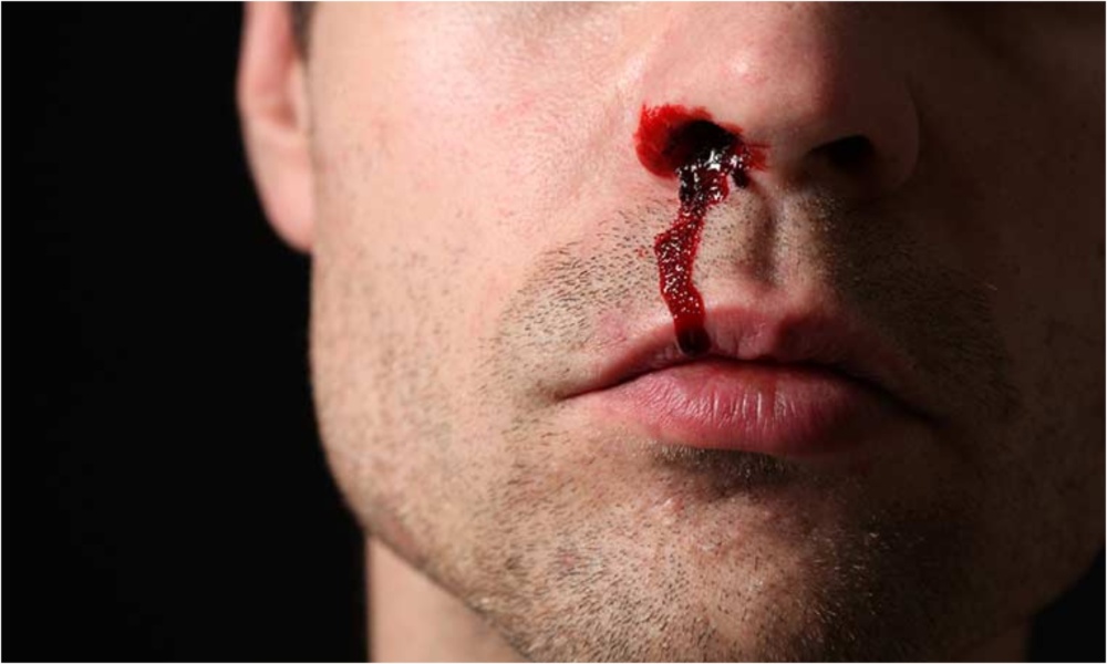Nose Bleeding: తరచూ ముక్కు నుంచి రక్తం కారుతుందా… ఇది దేనికి సంకేతమో తెలుసా?
