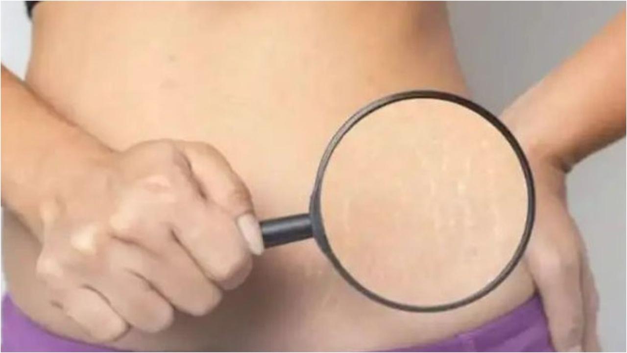 Beauty Tips: స్ట్రెచ్ మార్క్స్ మీ అందాన్ని చెడగొడుతున్నాయా… ఈ చిట్కాతో చెక్ పెట్టండి?