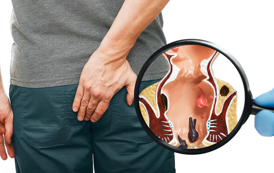 పైల్స్ సమస్యతో బాధపడుతున్నారా.. సమస్యకు చెక్ పెట్టే అద్భుతమైన చిట్కాలివే!