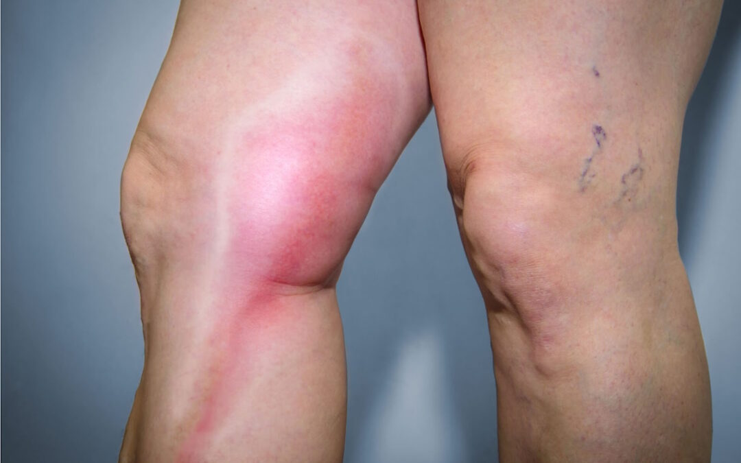 శరీరంలో రక్తం గడ్డ కట్టడానికి అసలు కారణాలివే.. ఈ షాకింగ్ విషయాలు మీకు తెలుసా?