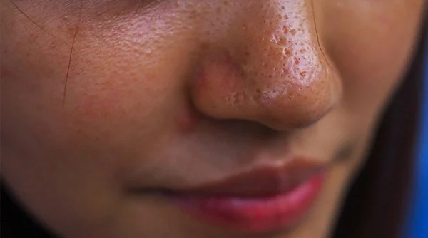 జిడ్డు చర్మానికి చెక్ పెట్టాలని అనుకుంటున్నారా.. చెక్ పెట్టే క్రేజీ చిట్కాలివే!