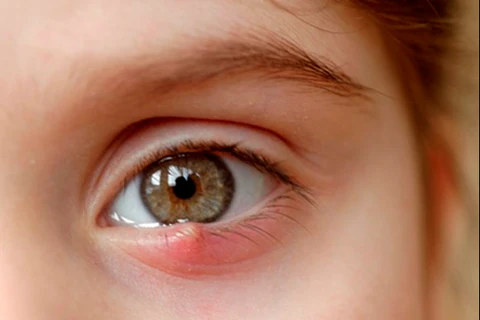 తరచుగా కళ్లు మండుతున్నాయా.. ఈ చిట్కాలు పాటిస్తే సమస్యకు పూర్తిగా చెక్!