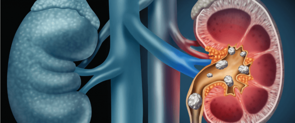 కిడ్నీలో రాళ్లను సులువుగా కరిగించే చిట్కాలివే.. ఈ షాకింగ్ విషయాలు తెలుసా?